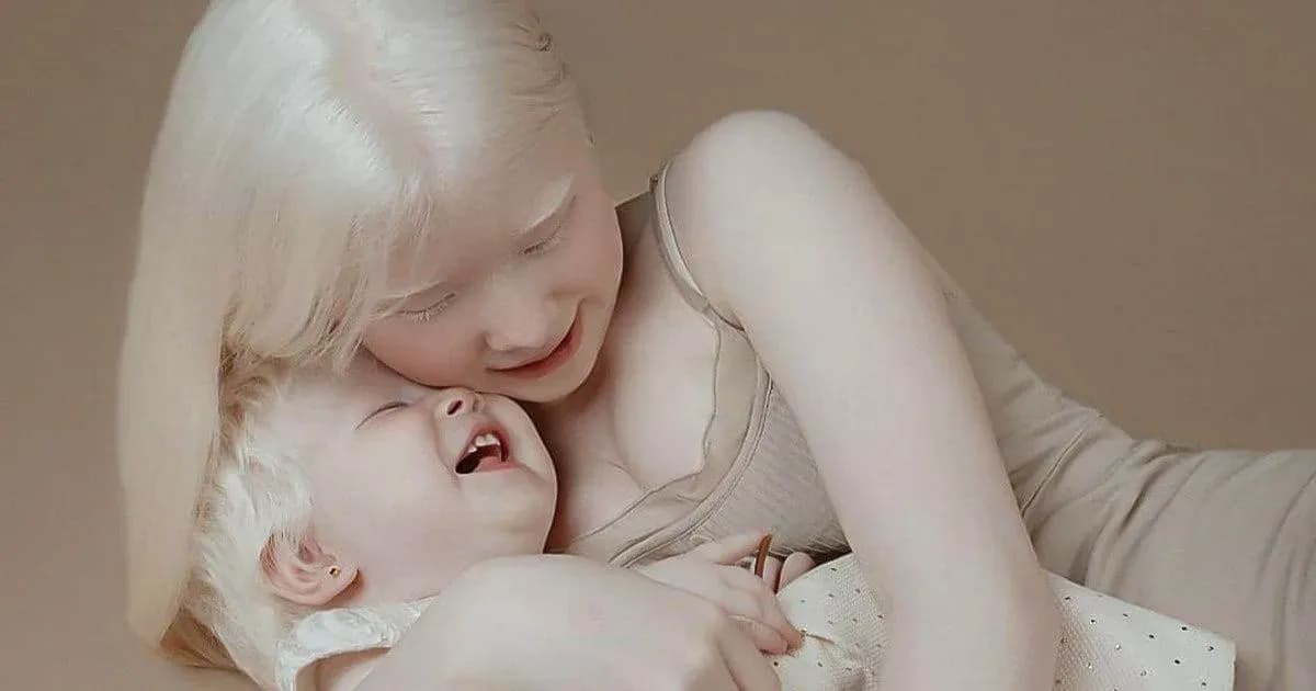 Sestre albino rođene u razmaku od 12 godina oduševile internet